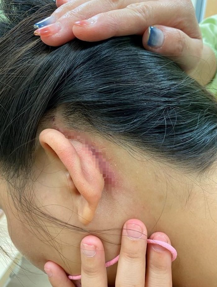 新舊電子耳移植 開創輔醫先例